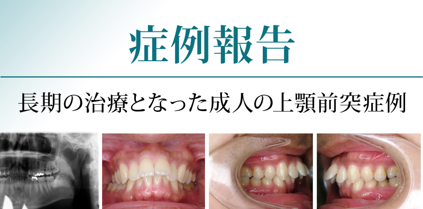 症例報告 長期の治療となった成人の上顎前突症例 歯科医療従事者のための総合情報サイト Dentwave Com